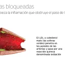 Formación de ateroma.