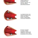 Formación de ateroma