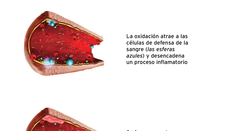 Formación de ateroma