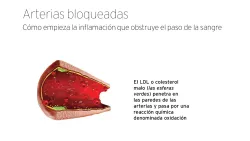 Formación de ateroma.
