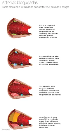 Formación de ateroma